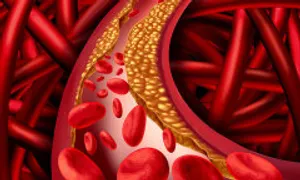 Dấu hiệu ở chân cảnh báo cholesterol cao Dấu hiệu ở chân cảnh báo cholesterol cao